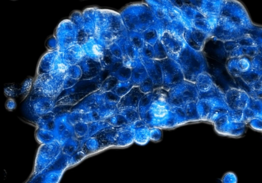 Abbildung 1: Die neue Strategie aktiviert den Wirkstoff (blau fluoreszierend) spezifisch im sauerstoffarmen Tumorgewebe (© Diana Groza)